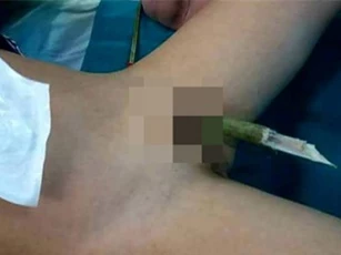 Bé trai 9 tuổi bị cành nhãn đâm xuyên "của quý"