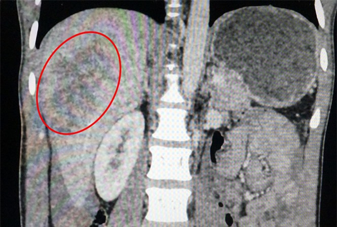 Bánh xe tải phát nổ, ép vỡ gan người đàn ông bơm xe