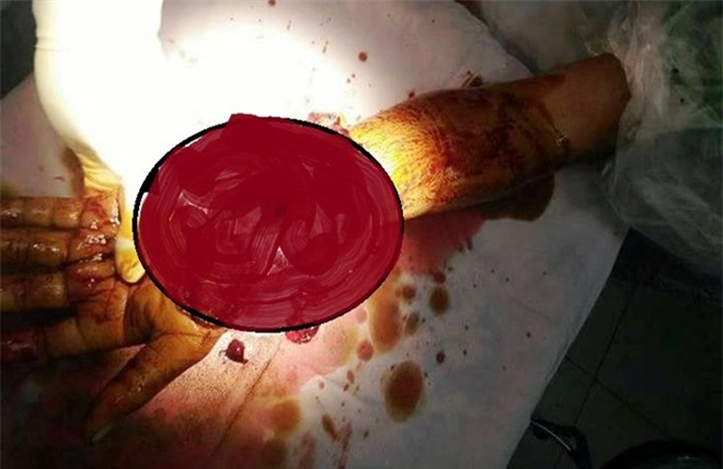 Kinh hoàng thanh niên bị chém gần đứt lìa cẳng tay