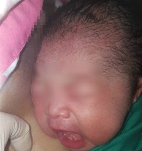 Sốc: Bé gái vừa chào đời đã mọc 2 chiếc răng ở hàm dưới