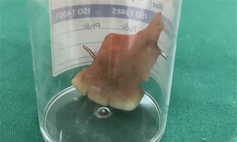 Thanh niên nhập viện sau tiệc cưới vì lỡ nuốt 3 chiếc răng giả