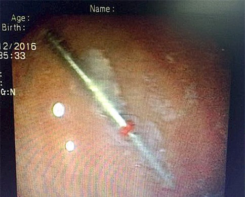 Nha sĩ làm rơi mũi khoan dài 3cm vào họng bệnh nhân