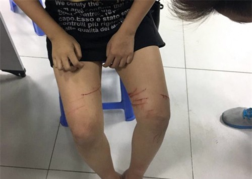 Nữ sinh trình báo bị kẻ xấu rạch đùi bằng dao lam 