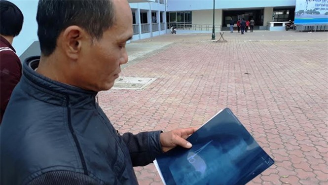 Bác sĩ để quên kéo trong bụng bệnh nhân 18 năm