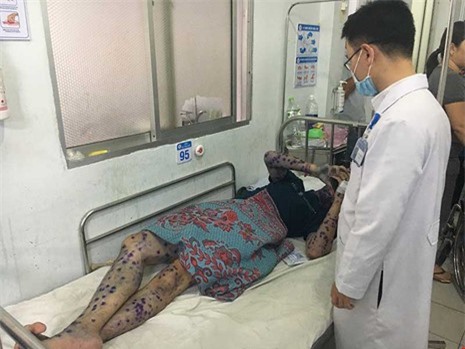 "Ổ" dịch thủy đậu tại khu chế xuất Tân Thuận, TP. HCM