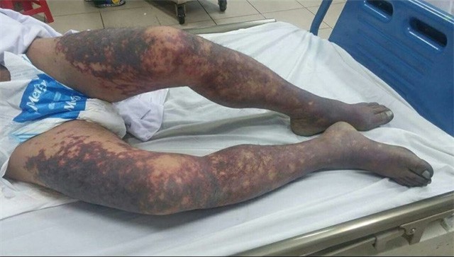 Ăn tiết canh lợn cắp nách, 1 người bị hoại tử toàn thân