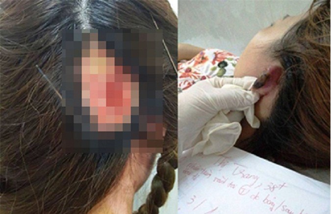 Làm đẹp đón Tết, 2 phụ nữ bị hoại tử vành tai, mất da đầu