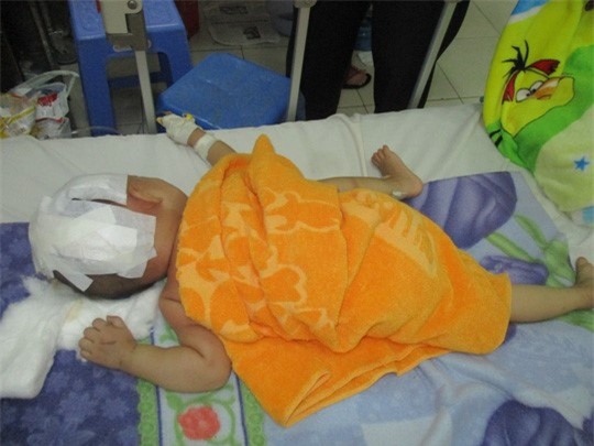 Bé trai 15 tháng tuổi nứt sọ vì ngã văng khỏi xe máy