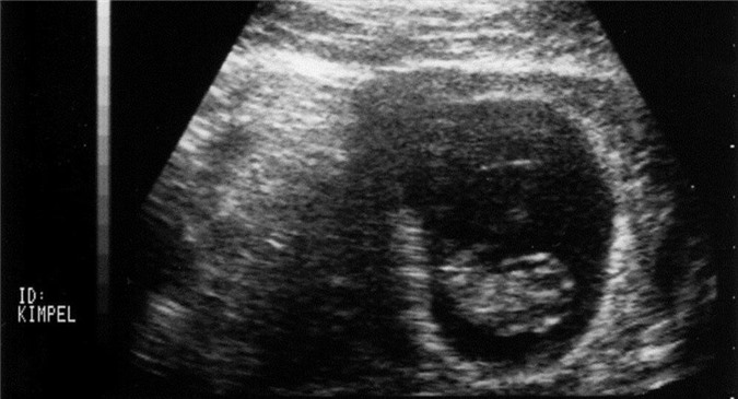 Tin sốc: Lần đầu tiên trong lịch sử có người đàn ông mang thai