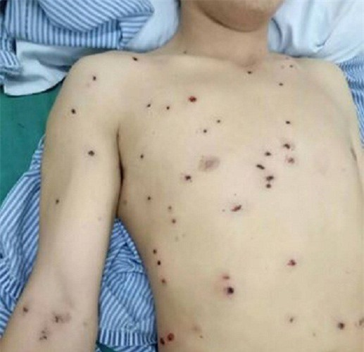 Thanh niên bị nã 50 phát đạn bằng súng hoa cải 