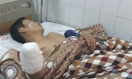 Mù mắt, cụt tay do đốt pháo hoa ngày mùng 1 Tết