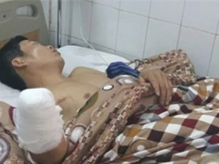 Mù mắt, cụt tay do đốt pháo hoa ngày mùng 1 Tết