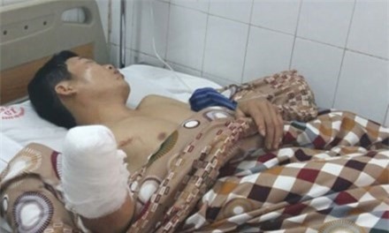 Người cụt tay, kẻ mù mắt vì rủ nhau đốt pháo đêm Giao thừa