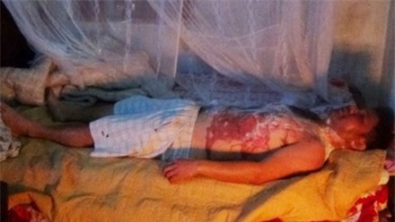 Uống rượu say ngày Tết, chồng bị vợ tưới nước sôi lên người