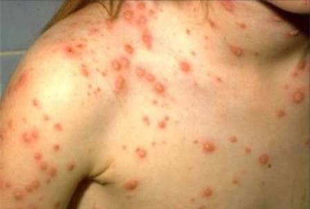 Mắc bệnh thủy đậu, cần tránh những thực phẩm nào?