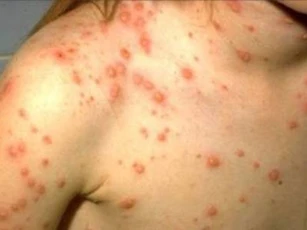 Mắc bệnh thủy đậu, cần tránh những thực phẩm nào?
