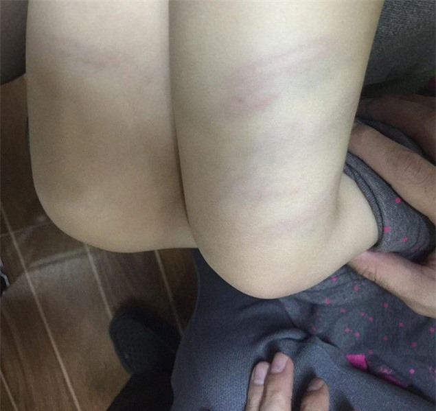 Bé hơn 2 tuổi bị cô giáo mầm non đánh bầm tím đùi