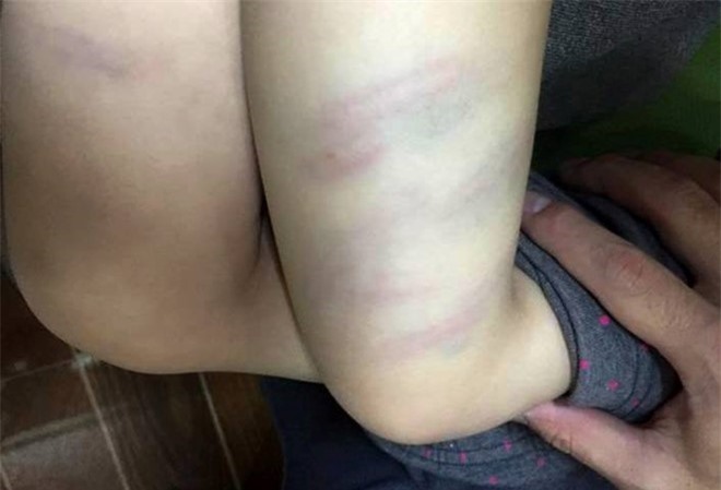 Đuổi việc cô giáo mầm non đánh trẻ tím đùi ở Thanh Hóa