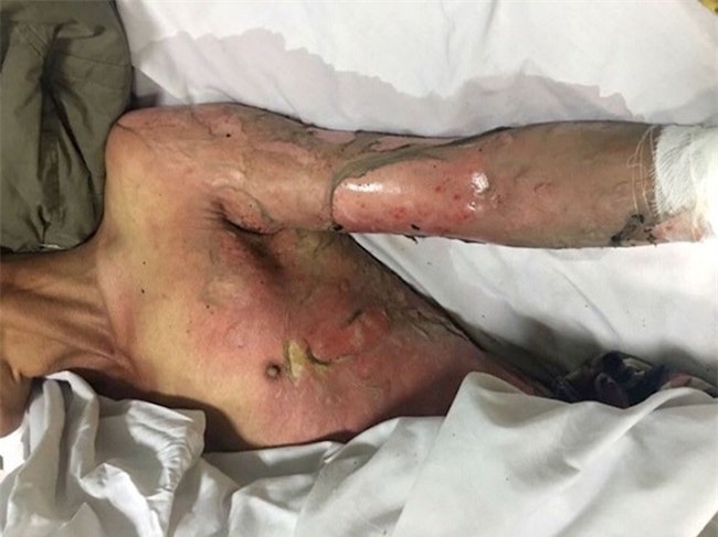 Không cho khách nợ 30 nghìn, chủ quán bida bị thiêu đến tuột da