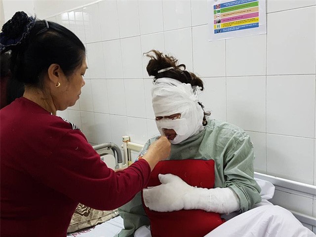 Bóng bay phát nổ, 2 cô gái bị bỏng toàn bộ khuôn mặt 