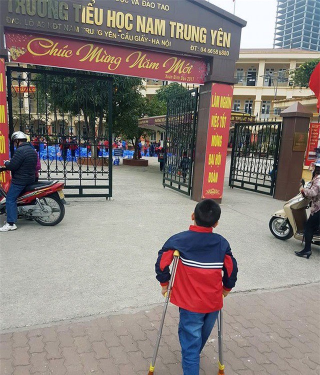 Học sinh bị gẫy chân ở trường: Nạn nhân bị thương tật 32%