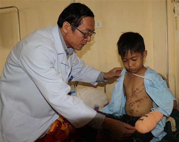 Hà Tĩnh: Nghịch kíp mìn, bé trai 8 tuổi bị tháo 4 đốt ngón tay