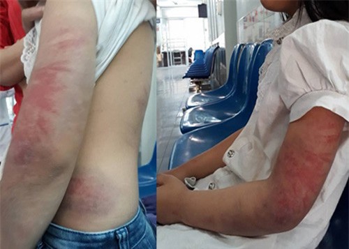 Phẫn nộ ông bố say rượu đánh con gái 9 tuổi bầm tím người