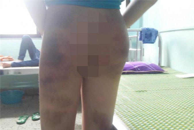 Học viên bị thầy giáo đánh bầm tím vì nghi trộm điện thoại