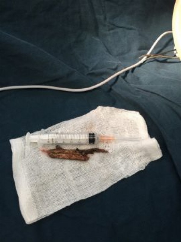 Chiến đấu tử thần, cứu bé trai 9 tuổi bị cành cây đâm xuyên cổ