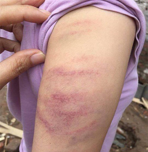 Không làm đủ bài tập, học sinh bị đánh tím tay