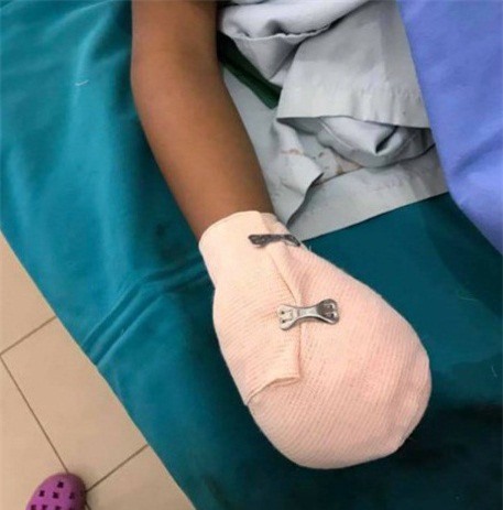 Pin điện thoại phát nổ khi đang sạc, bé trai nát bàn tay