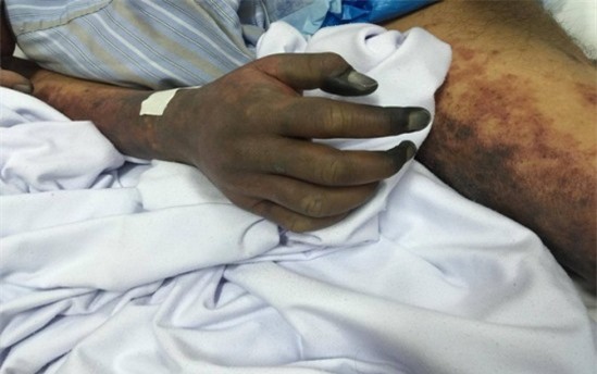 Làm rõ vụ thanh niên tử vong nghi nhiễm liên cầu lợn