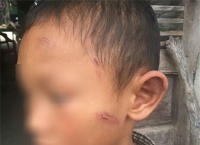 Bé trai 5 tuổi bị dì ruột đánh bầm tím, rỉ máu khắp người