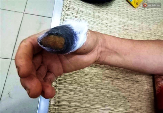 Vì nắm rau mồng tơi, 2 người phụ nữ ẩu đả cắn đứt 1 ngón tay