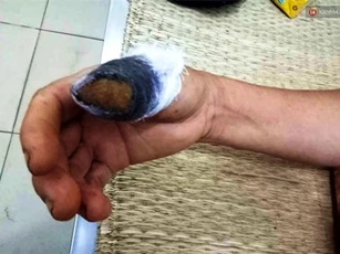 Vì nắm rau mồng tơi, 2 người phụ nữ ẩu đả cắn đứt 1 ngón tay