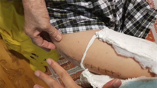 Không khởi tố tài xế tông gãy chân học sinh trường Nam Trung Yên