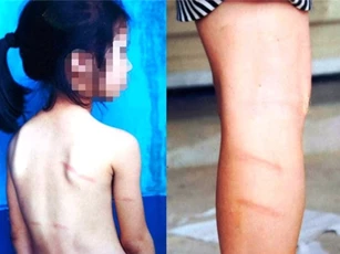 Học sinh bị đánh bầm tím lưng và chân vì không làm được bài