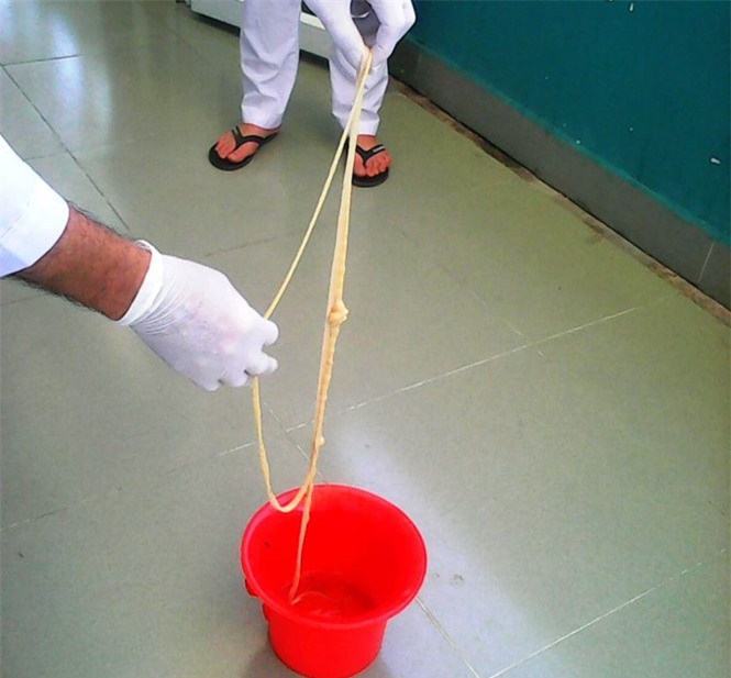 Xổ thành công sán xơ mít dài gần 10 m trong người bệnh nhân