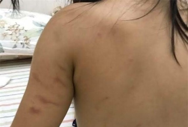 Bé 2 tuổi bị bầm tím tay bất thường ở trường mầm non