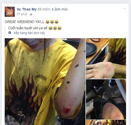 Thảo My The Voice gặp tai nạn, toàn thân bị trầy xước rớm máu