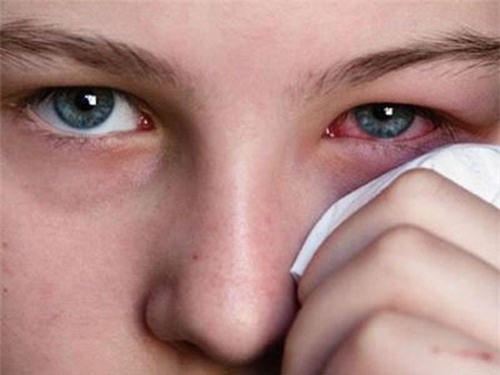 Đau mắt đỏ và những điều bạn cần biết