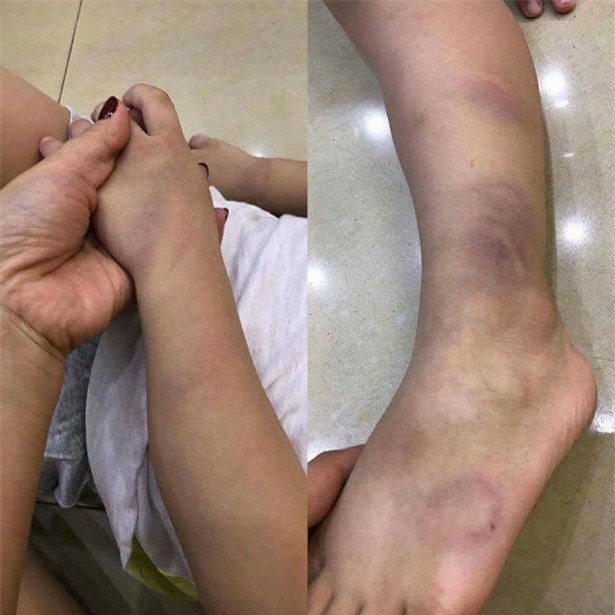 Xôn xao bé trai 3 tuổi bị cô giáo đánh bầm tím tay chân