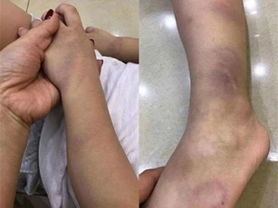 Xôn xao bé trai 3 tuổi bị cô giáo đánh bầm tím tay chân