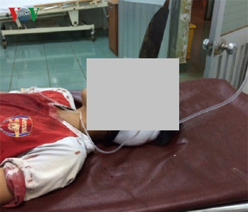 Cứu sống bé trai 12 tuổi bị dao văng giữa trán