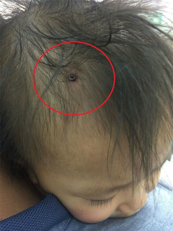 Sốc: Phát hiện đinh vít cắm vào đầu em bé