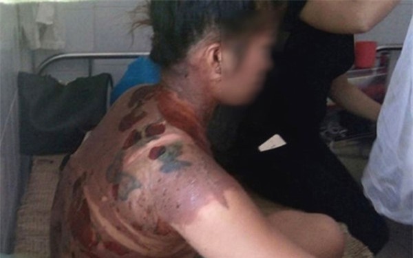 Chồng tàn nhẫn hắt nước sôi vào người vợ: Khởi tố vụ án