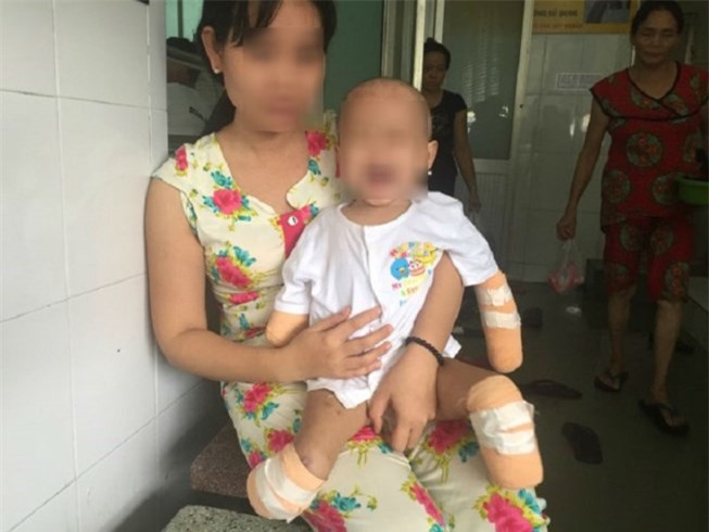 Xót thương bé 2 tuổi phải cắt 4 chi vì viêm não mô cầu