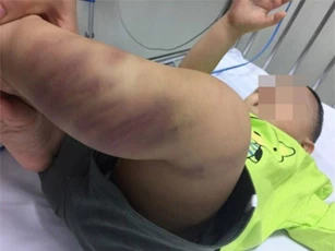 Bé trai hơn 1 tuổi bị bỏ rơi, nghi bị bạo hành dã man