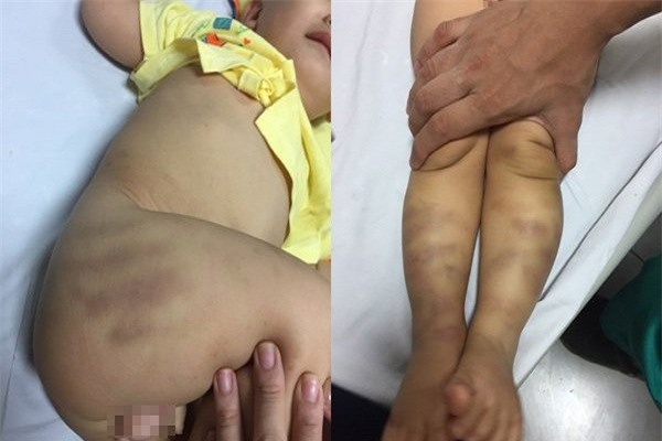 Bé trai 1 tuổi bị bạo hành: Nghi can có thể bị truy tố tội giết người 