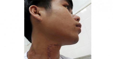 Nam thanh niên bị trâu nhà hàng xóm húc thủng cổ, rách khí quản
